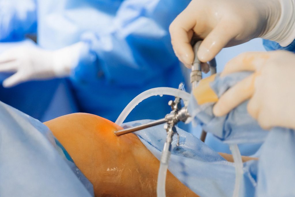 What Is Arthroscopic Surgery: A Complete Guide for Patients