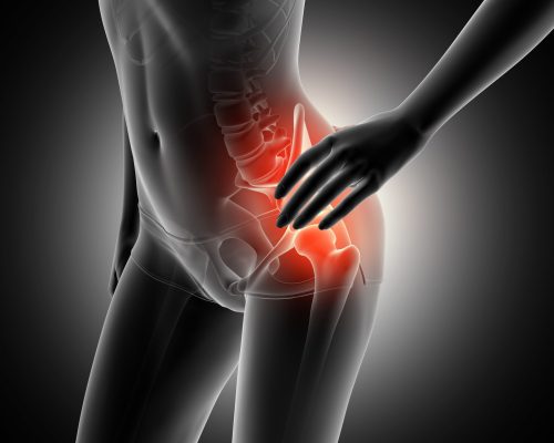 3D female figure holding hip in pain with skeleton highlighted hip replacement causes
