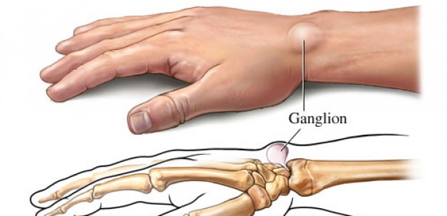 Ganglion Cyst Treatment in Hyderabad