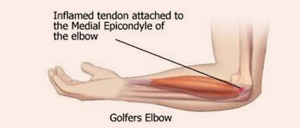 Golfers Elbow Surgery in Hyderabad