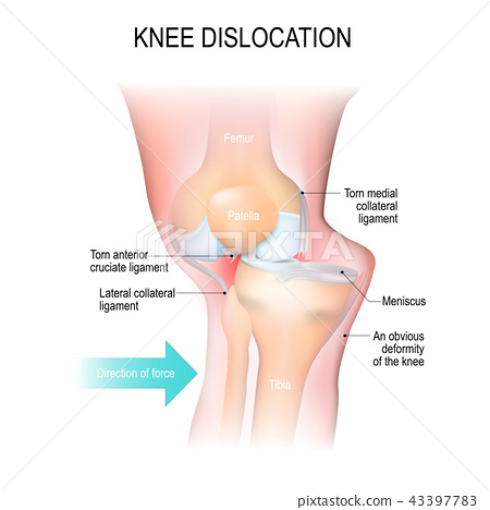 Knee Dislocation Treatment