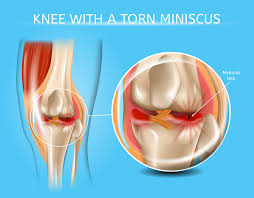 Knee Meniscal Tear Treatment