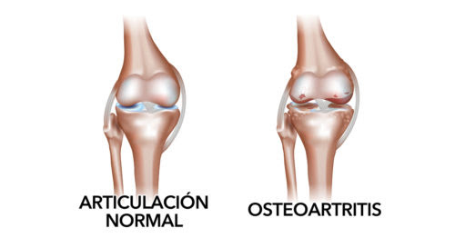 Knee Osteoarthritis Treatment in Hyderabad