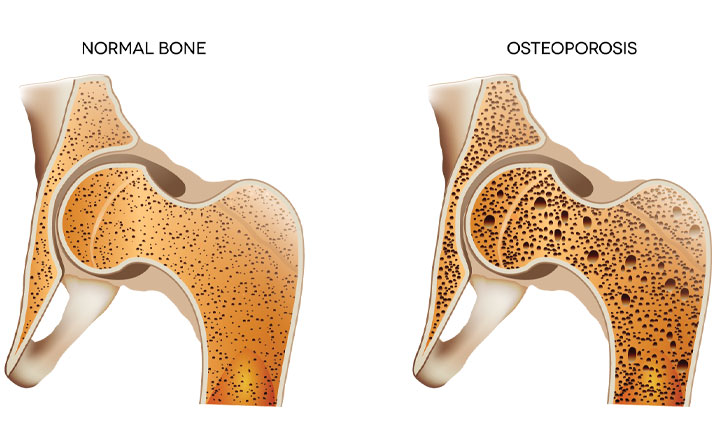 Best Osteoporosis Treatment 