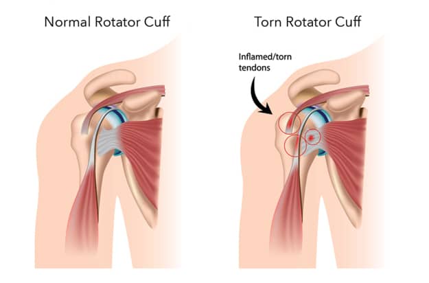 Best Shoulder Rotator Cuff Injury Treatment In Hyderabad