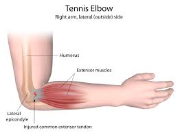 Best Tennis Elbow Treatment